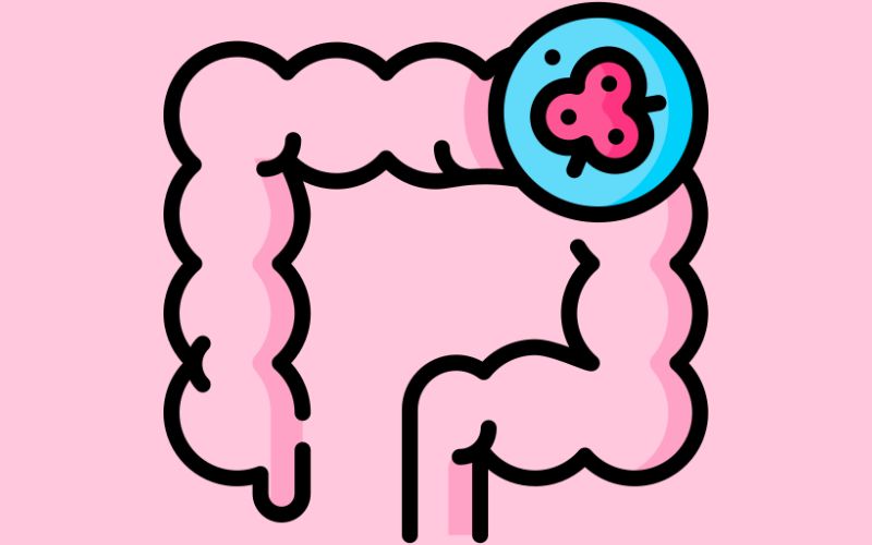 Ung thư đại tràng giai đoạn 1 thường không quá nguy hiểm