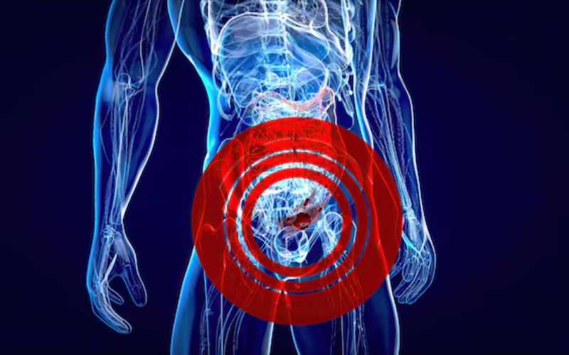 Ung thư đại tràng giai đoạn đầu: Dấu hiệu nhận biết