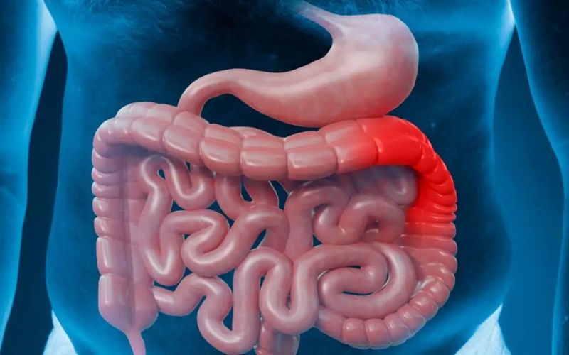 Chảy máu trong viêm ruột cần được chẩn đoán phân biệt với các nguyên nhân khác