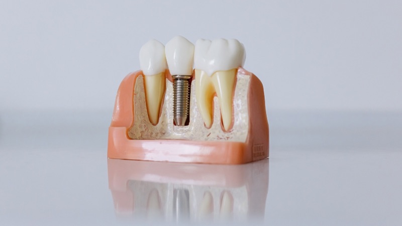 Răng giả tháo lắp trên trụ implant kết hợp giữa việc gắn implant vào trong xương hàm và hàm giả tháo lắp