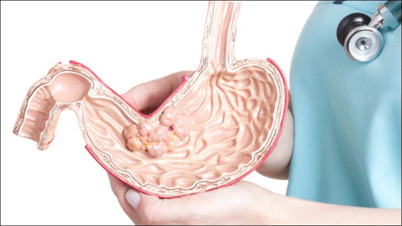 Y học hiện đại có nhiều phương pháp điều trị ung thư dạ dày hiệu quả