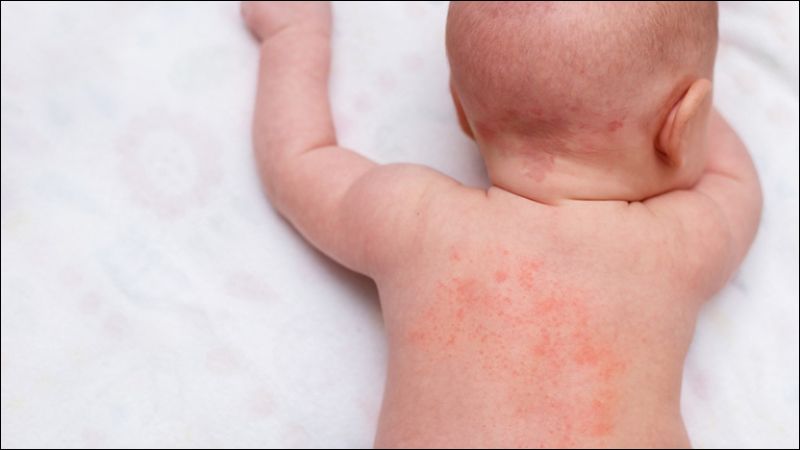 Viêm da cơ địa trẻ em là một bệnh lý viêm da mạn tính, thường gặp ở trẻ em, đặc biệt là trẻ sơ sinh và trẻ nhỏ