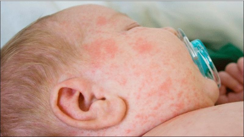 Viêm da cơ địa ở trẻ em thường khởi phát từ rất sớm, đặc biệt phổ biến ở trẻ sơ sinh và trẻ nhỏ