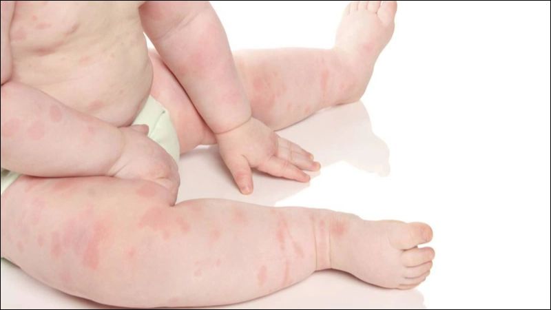 Nguyên nhân gây viêm da cơ địa của trẻ có thể do các yếu tố di truyền hoặc đến từ các tác nhân môi trường