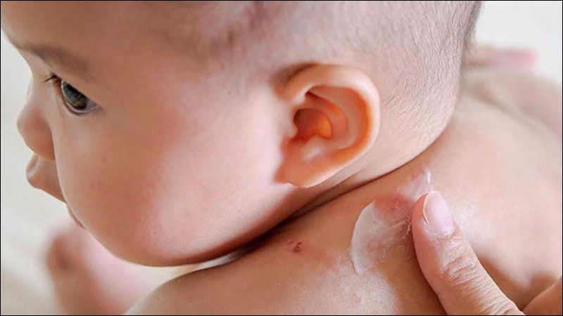 Dưỡng ẩm là nền tảng trong chăm sóc và điều trị viêm da cơ địa