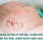 Viêm da cơ địa ở trẻ em: Chăm sóc da bé dịu nhẹ, giảm ngứa hiệu quả