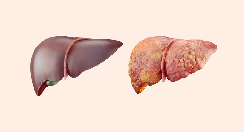 Xơ gan xảy ra khi gan bị tổn thương kéo dài, dẫn đến hình thành mô sẹo và mất dần chức năng