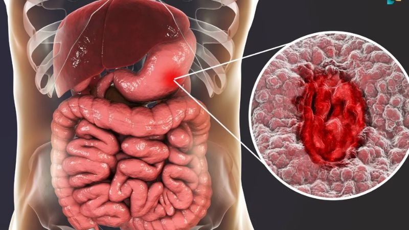 Viêm loét dạ dày nếu không được điều trị có thể dẫn đến nhiều biến chứng nguy hiểm