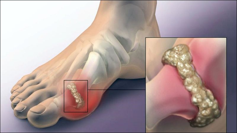 Bệnh gout là một loại rối loạn chuyển hóa gây tích tụ axit uric tại khớp gây viêm, sưng, đỏ và đau dữ dội