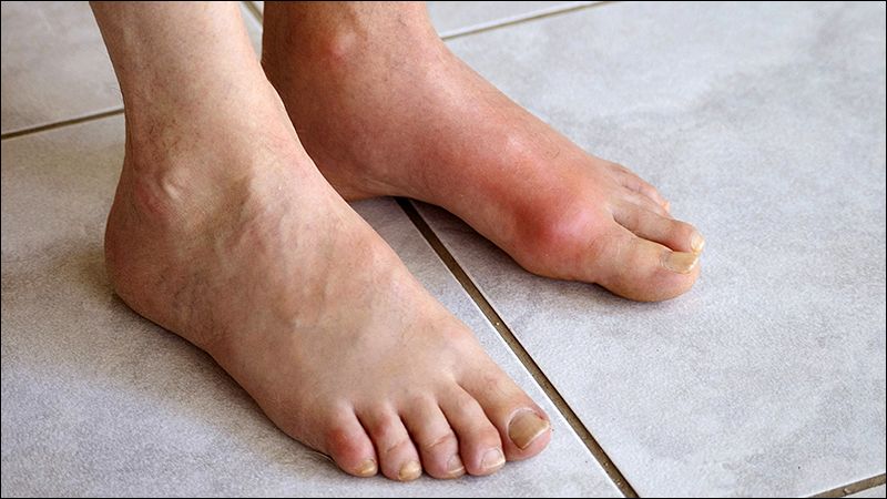 Biểu hiện điển hình của bệnh gout là đau dữ dội, sưng, đỏ, nóng khớp