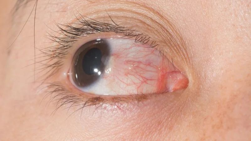 Mộng mắt là sự phát triển quá mức của kết mạc, tạo thành một vùng mô hình cánh hoặc tam giác nhô lên ở phần tròng trắng của mắt