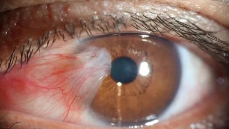 Thời gian phục hồi sau phẫu thuật mộng mắt có thể kéo dài từ vài tuần đến 1-3 tháng, tùy thuộc vào nhiều yếu tố