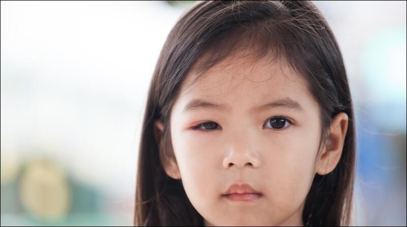 Viêm mô tế bào quanh hốc mắt là tình trạng nhiễm trùng lan vào các mô mềm quanh mắt, gây sưng, đau, đỏ