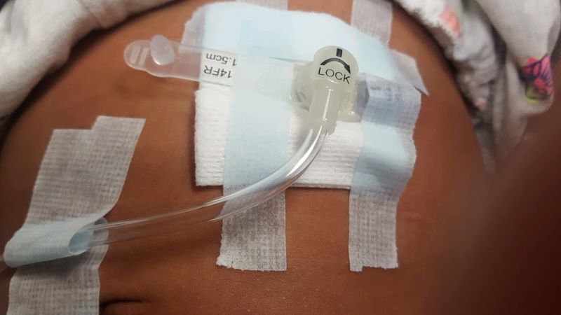 Việc đặt sonde dạ dày không quá phức tạp, nhưng cần được thực hiện đúng kỹ thuật để đảm bảo an toàn và hiệu quả