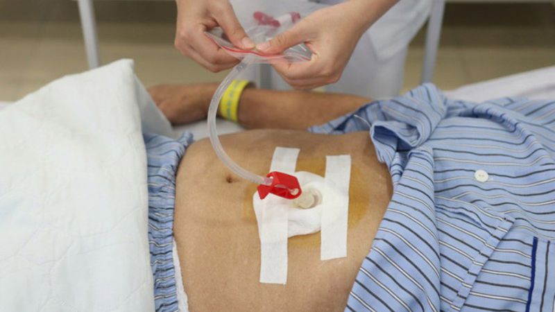 Sonde dạ dày thường được chỉ định cho những bệnh nhân hôn mê, tai biến,...