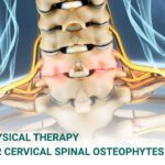 Physical Therapy for Cervical Spinal Osteophytes