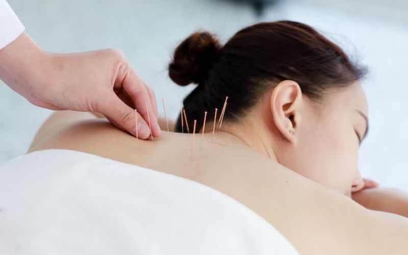 Acupuncture uses fine needles at specific points to stimulate energy flow and relieve pain, often treating conditions like back pain