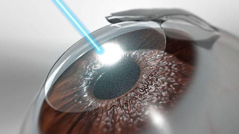 LASIK sử dụng dao vi phẫu tự động để tạo một vạt mỏng trên bề mặt giác mạc, sau đó dùng tia laser Excimer điều chỉnh độ cong