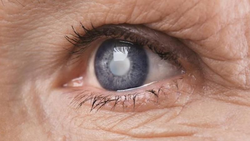 Đục thủy tinh thể là tình trạng thủy tinh thể mắt bị mờ, khiến ánh sáng khó truyền qua võng mạc, gây giảm thị lực