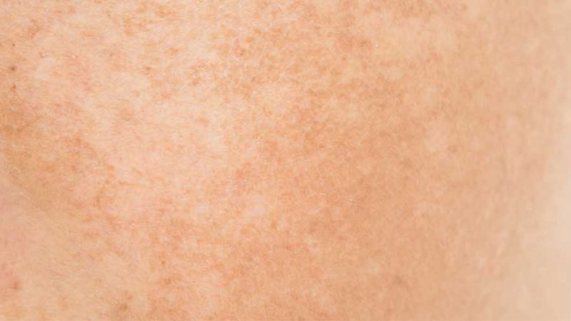 Nám thường biểu hiện bằng những mảng hoặc đốm nâu sẫm hơn màu da tự nhiên