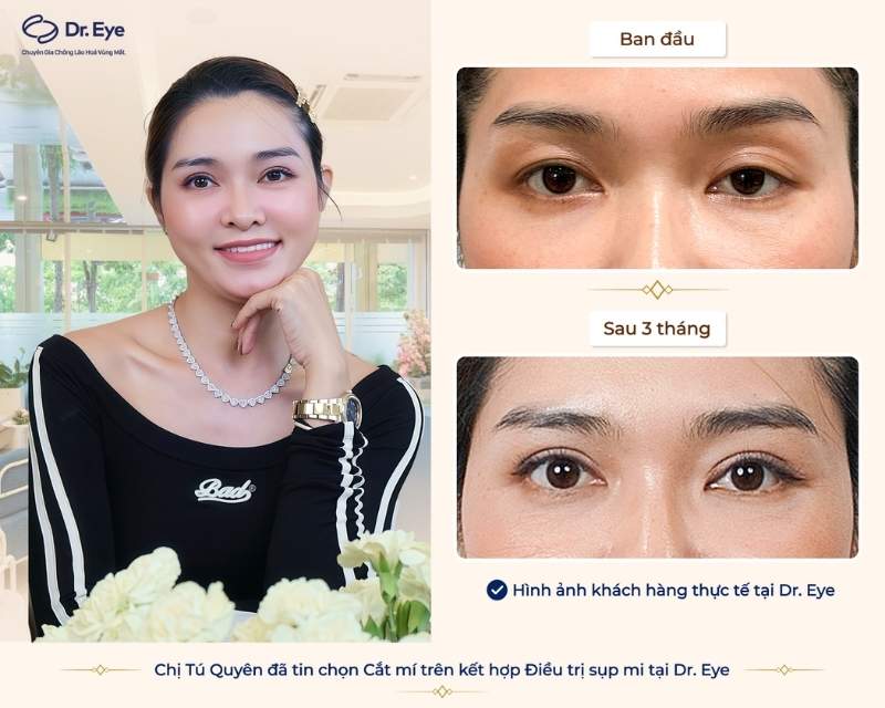 Hình ảnh khách hàng thực tế tại Dr. Eye - Chuyên gia chống lão hóa vùng mắt