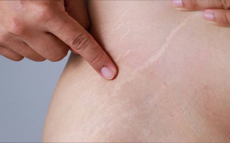 Rạn da là các vết nứt trên da do collagen và elastin bị đứt gãy khi da căng giãn quá nhanh, thường gặp ở phụ nữ sau sinh