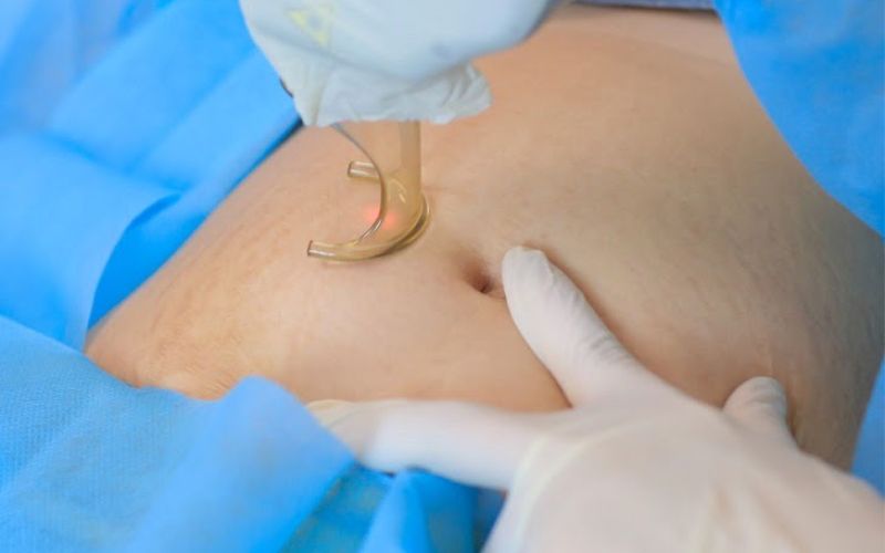 Điều trị rạn da được thiết kế cá nhân hóa, kết hợp nhiều công nghệ hiện đại