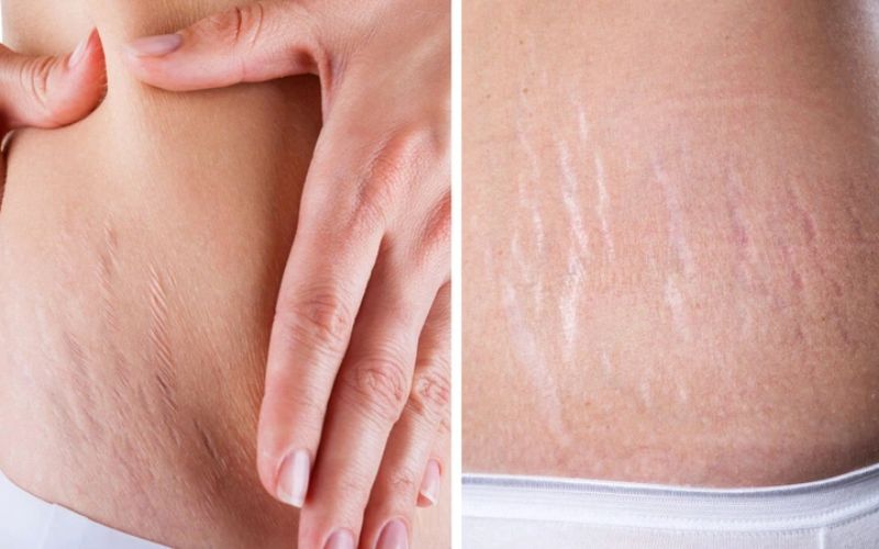 Điều trị rạn da cần thời gian để thấy rõ sự cải thiện