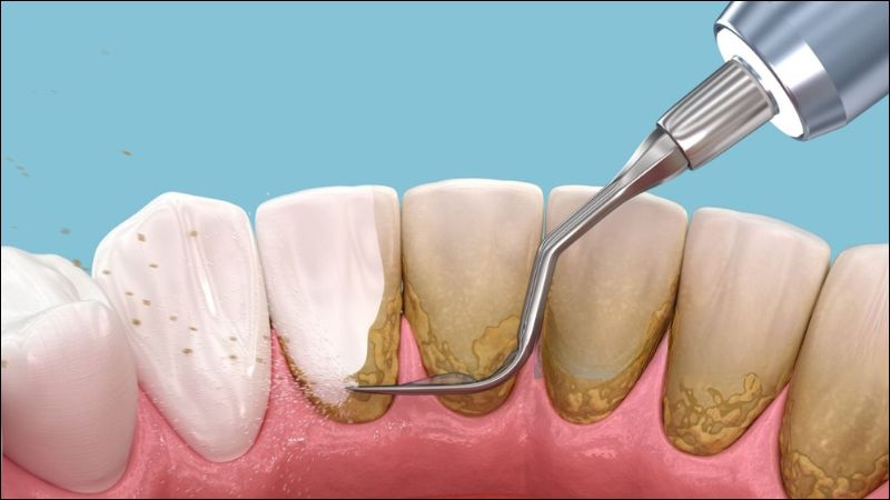 Chi phí cạo vôi răng và khám tổng quát thường dao động tùy theo mỗi phòng khám