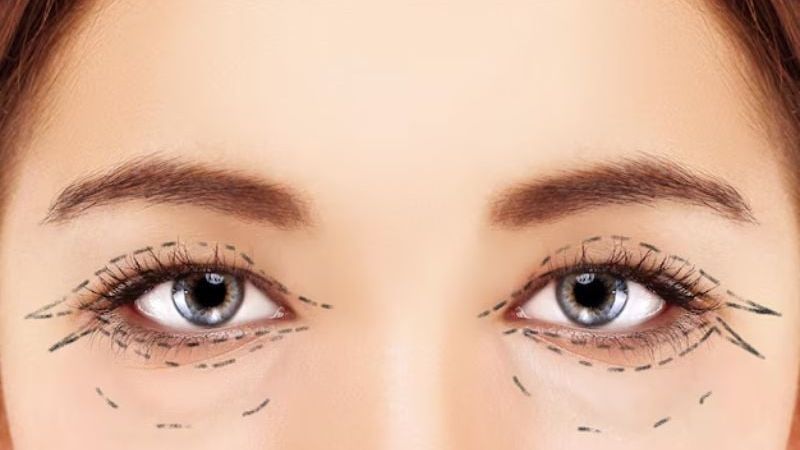 Cắt mí mắt là một thủ thuật thẩm mỹ giúp tạo hình mắt to tròn, sáng đẹp và tự nhiên hơn