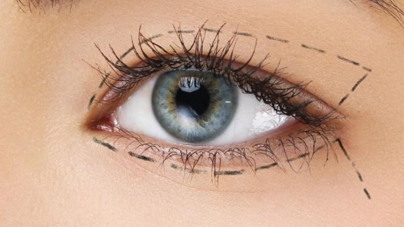 Kỹ thuật cắt mí mắt hiện nay được thực hiện nhanh chóng và an toàn