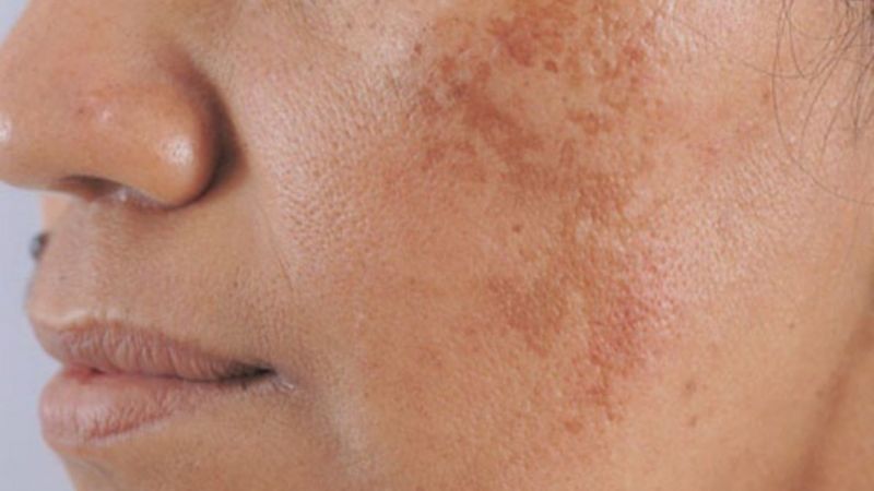 Nám da và tàn nhang không chỉ là vấn đề thẩm mỹ ảnh hưởng đến vẻ ngoài mà còn có thể tác động tiêu cực đến sự tự tin của phái đẹp