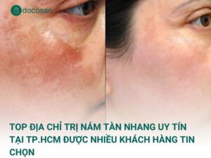 Top địa chỉ trị nám tàn nhang uy tín tại TP.HCM được nhiều khách hàng tin chọn