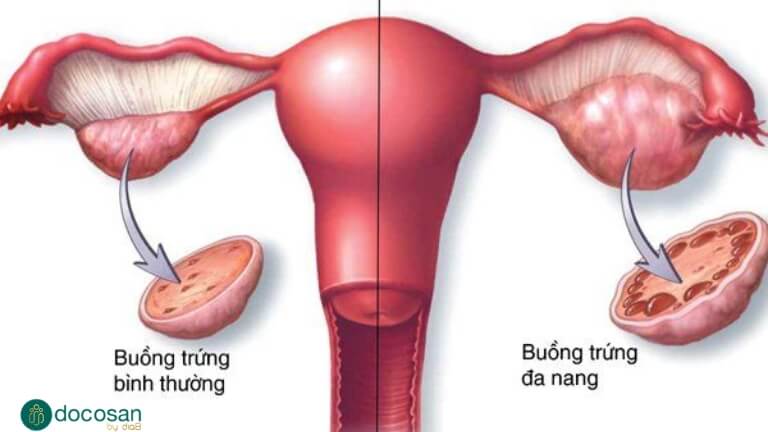 Khi nào cần khám buồng trứng đa nang