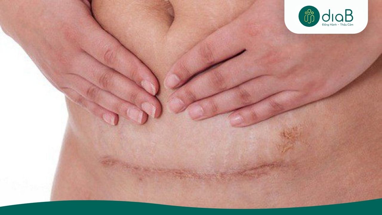 Các mẹ nên chờ khoảng khoảng 6 tháng sau sinh mổ mới bắt đầu giảm cân