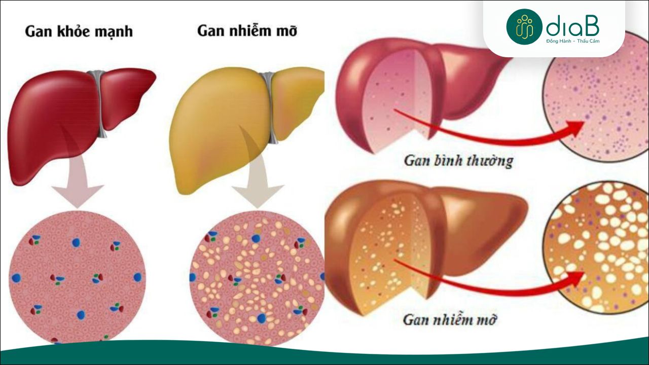 Bệnh gan nhiễm mỡ xảy ra khi chất béo tích tụ trong gan quá nhiều (Nguồn: Internet)