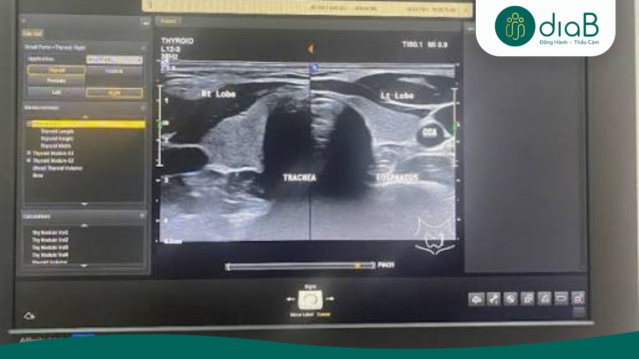 Siêu âm hạch cổ hỗ trợ đánh giá nguy cơ tổn thương tuyến giáp