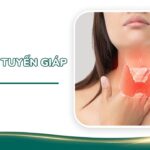 ung thư tuyến giáp