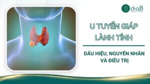 U tuyến giáp lành tính: Dấu hiệu, nguyên nhân và điều trị